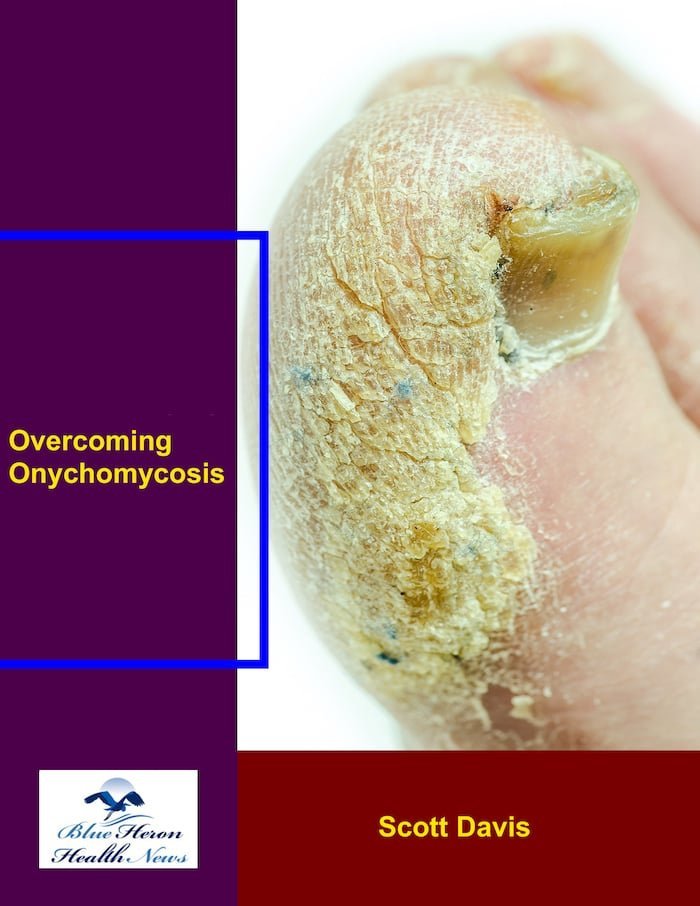 Overcoming Onychomycosis Review 1